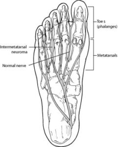 neuroma-foot-ankle-doctor-peoria-az